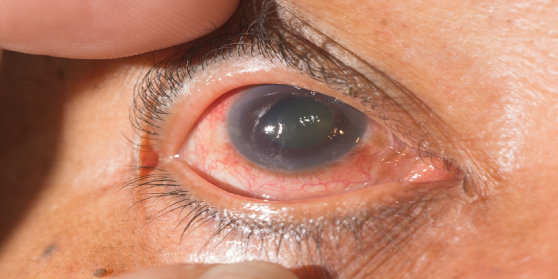 Glaucoma: The Silent Eye Disease That Can Lead to Vision Loss